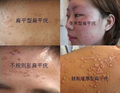 从图片上识别扁平疣的3大症状_太原皮肤科哪家医院最好_太原皮肤病